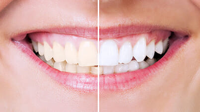 Răng sứ Zirconia và 5 lưu ý khi bọc răng sứ 2