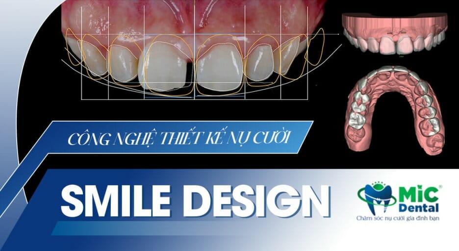 công nghệ hiện đại giảm thiểu tối đa bọc răng sứ có đau không
