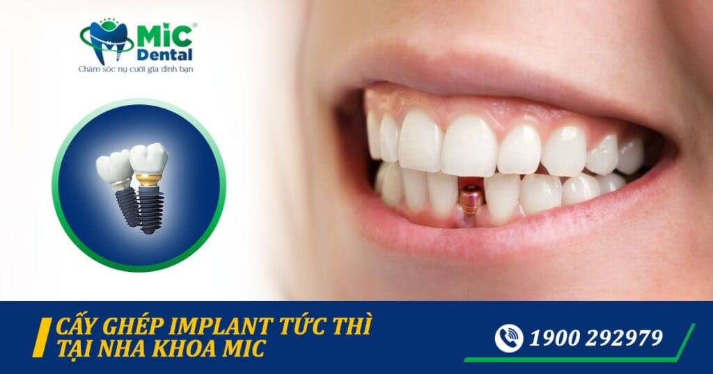 Trồng răng Implant giá bao nhiêu? Bảng giá Implant 2022 nha khoa MIC 6