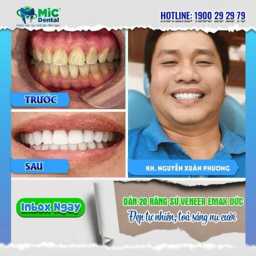Kết quả Khách hàng bọc răng sứ tại Nha kha MIC