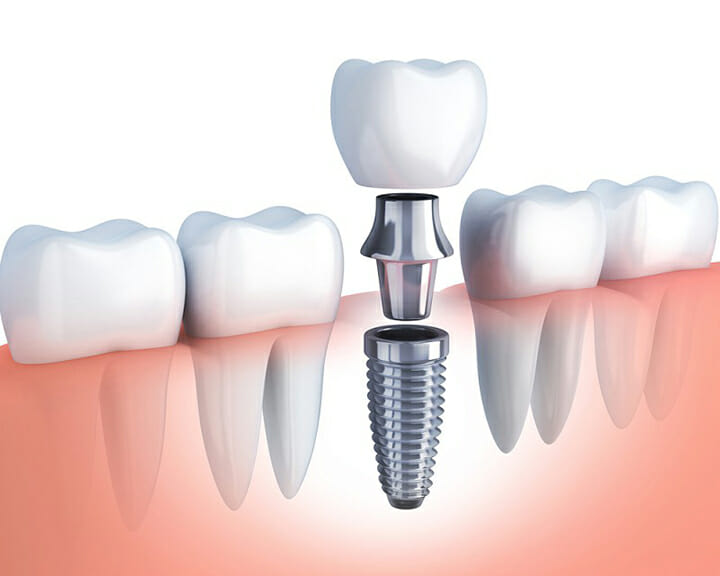Công nghệ trồng răng Implant và 3 yếu tố thành công 2