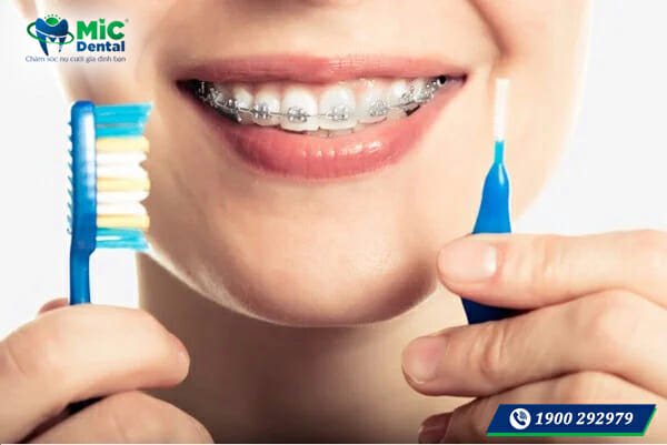 Niềng răng mắc cài sứ: 3 ưu điểm nên cân nhắc 2