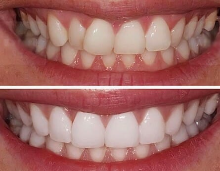 Niềng răng trong suốt giá bao nhiêu? 3 ưu điểm vượt trội 4