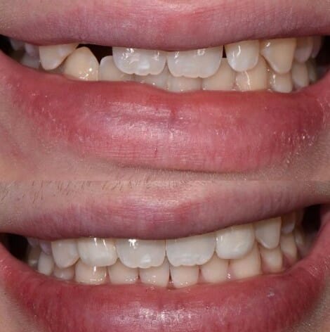 Niềng răng trong suốt giá bao nhiêu? 3 ưu điểm vượt trội 5