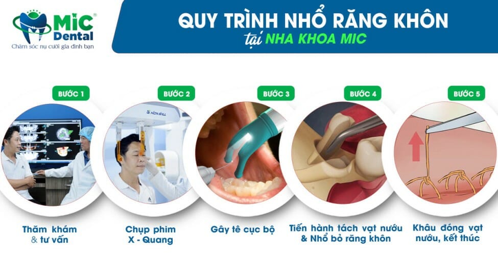 Tham khảo quy trình nhổ răng khôn tại nha khoa MIC