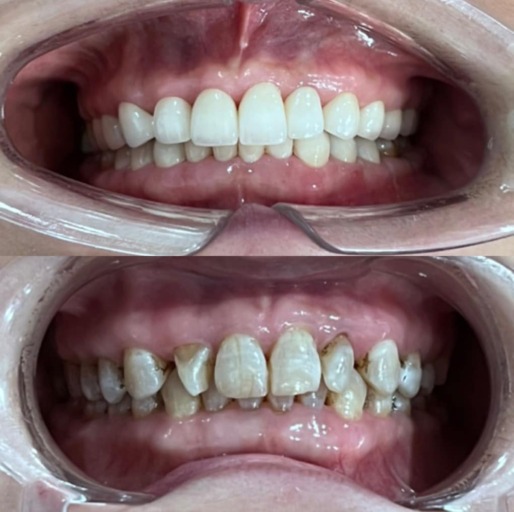 Răng sứ Zirconia và 5 lưu ý khi bọc răng sứ 5