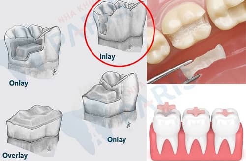 Trám răng là gì? 4 vật liệu trám thường gặp 1