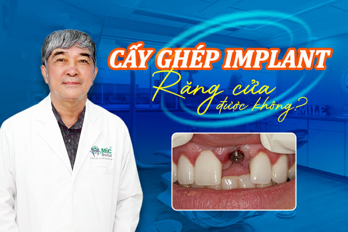 implant răng cửa