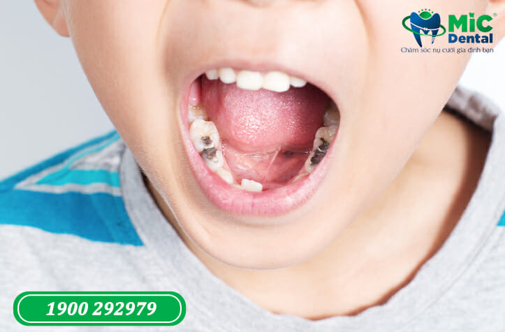 điều trị sâu răng cho trẻ