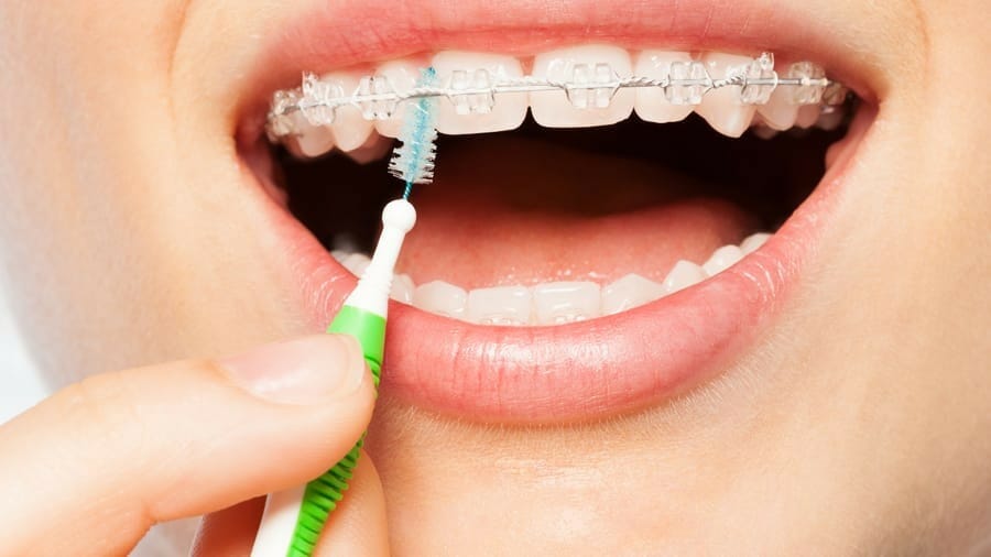 Cách đánh răng cho người niềng răng - Hướng dẫn từ A - Z 2
