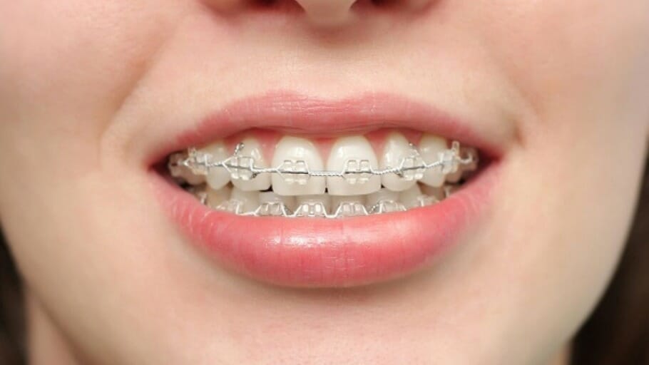 Cách đánh răng cho người niềng răng - Hướng dẫn từ nha sĩ 1