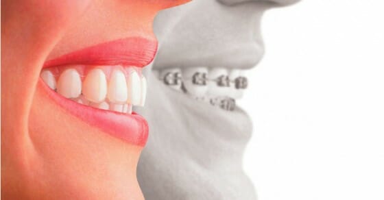 Cách làm răng hết hô tại nhà có thật sự hiệu quả? 2