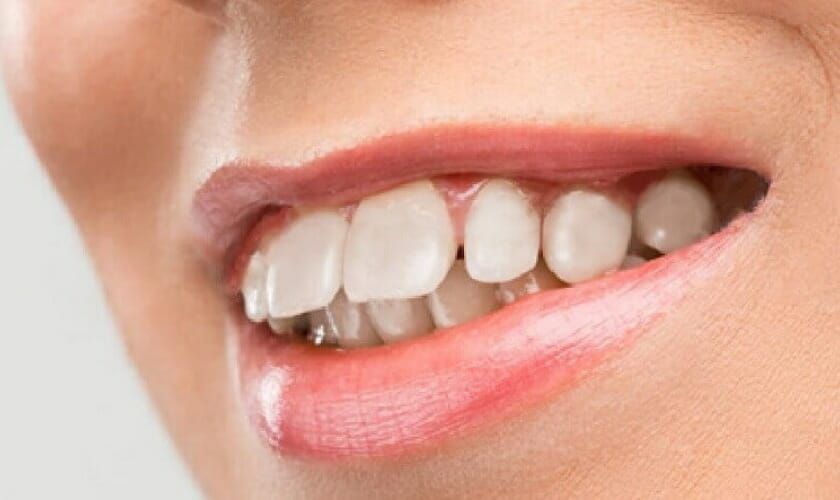 Cách làm răng hết hô tại nhà có thật sự hiệu quả? 12