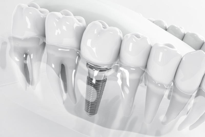 Trồng Răng Implant Giá Rẻ: Những Nguy Hiểm Tiềm Ẩn 8