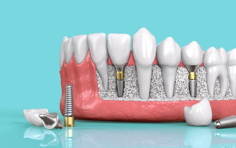 Bật mí 3 cách trồng răng hàm dưới tốt nhất hiện nay 2