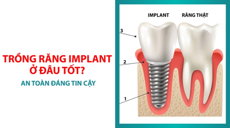 Trồng răng Implant ở đâu tốt nhất? Các tiêu chí đánh giá 1