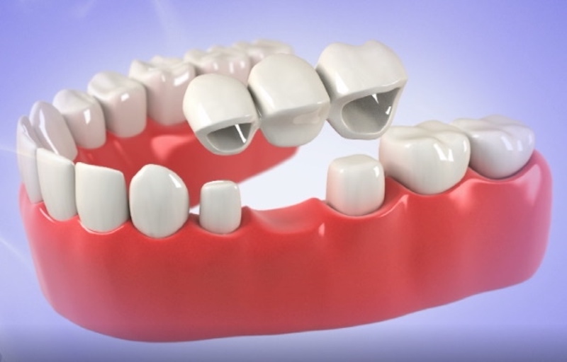 Trồng răng giả được bao lâu sẽ bị hư? Giải đáp chi tiết 3