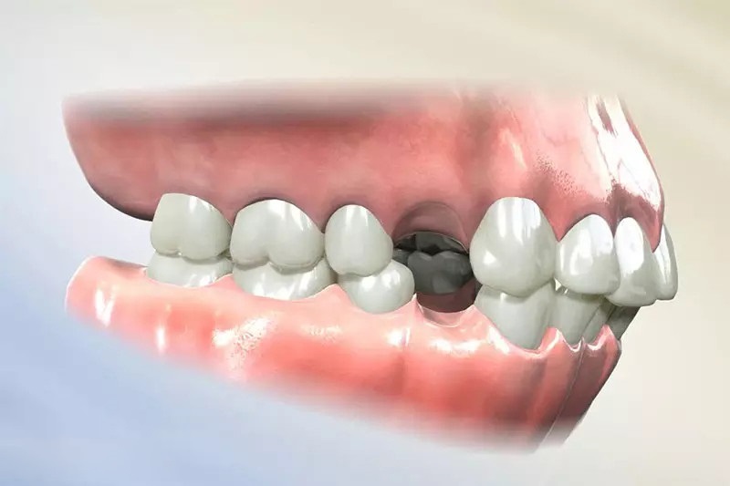 Mất răng số 4 hàm trên có ảnh hưởng gì không, có nguy hiểm không? 7