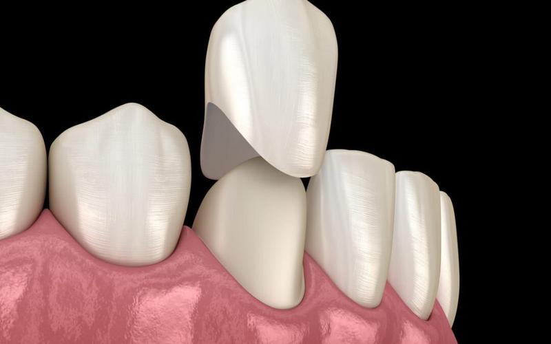 Bọc răng sứ có lấy tủy không? Có nên bọc răng sứ sau khi lấy tủy? 8