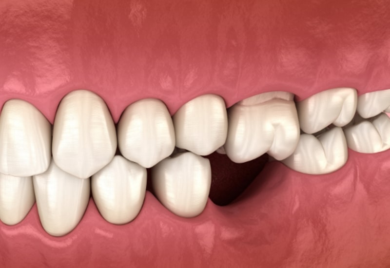 Mất răng hàm dưới gây nên nhiều vấn đề