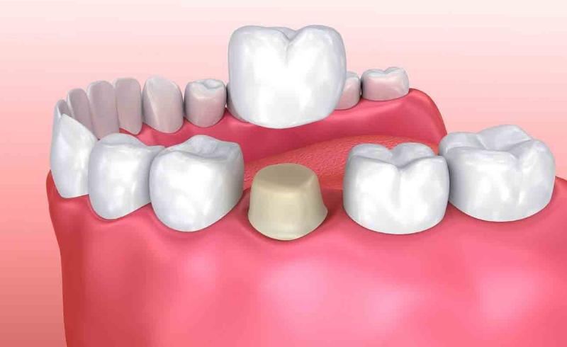 Bọc răng sứ có lấy tủy không? Có nên bọc răng sứ sau khi lấy tủy? 3