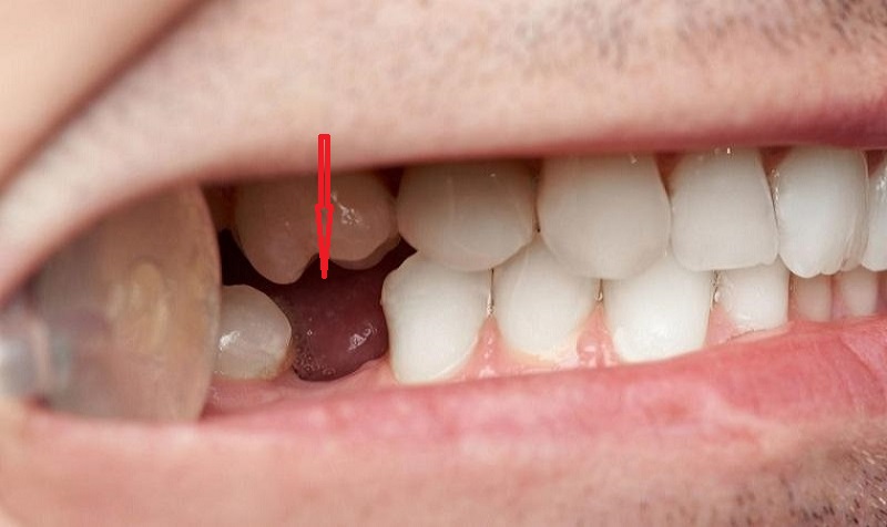 Có thể gây tiêu xương khi mất răng số 6