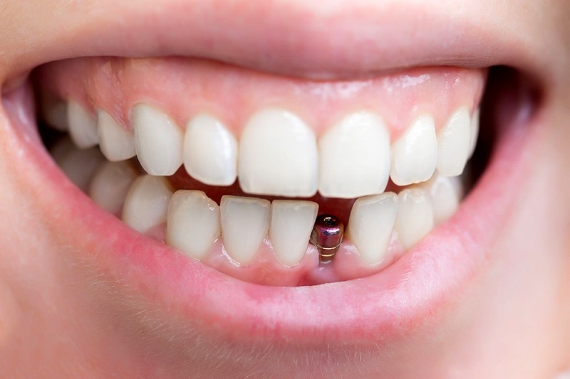 Trồng răng cửa Implant giúp giảm thiểu tổn thương