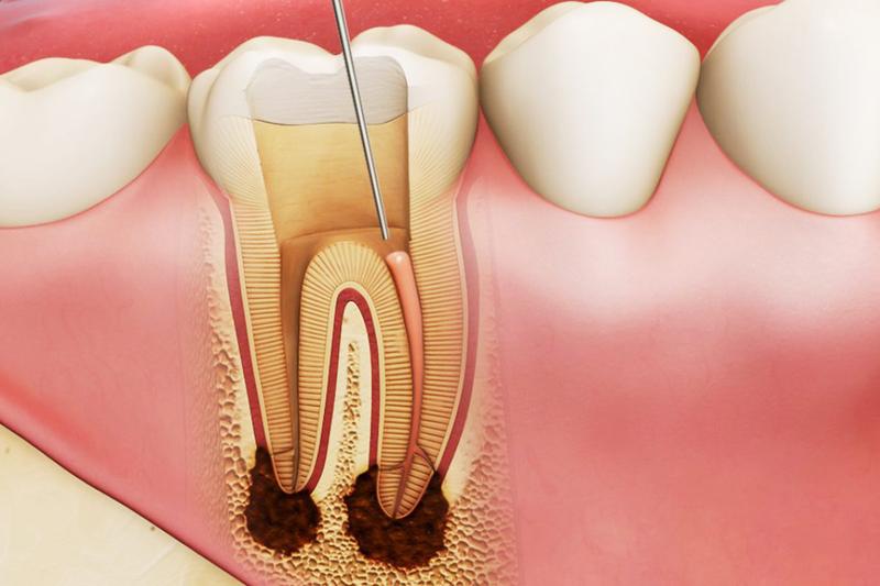 Bọc răng sứ có lấy tủy không? Có nên bọc răng sứ sau khi lấy tủy? 5