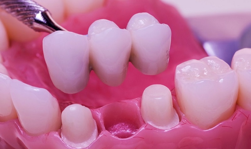 Cầu răng sứ mang lại khả năng nhai tốt