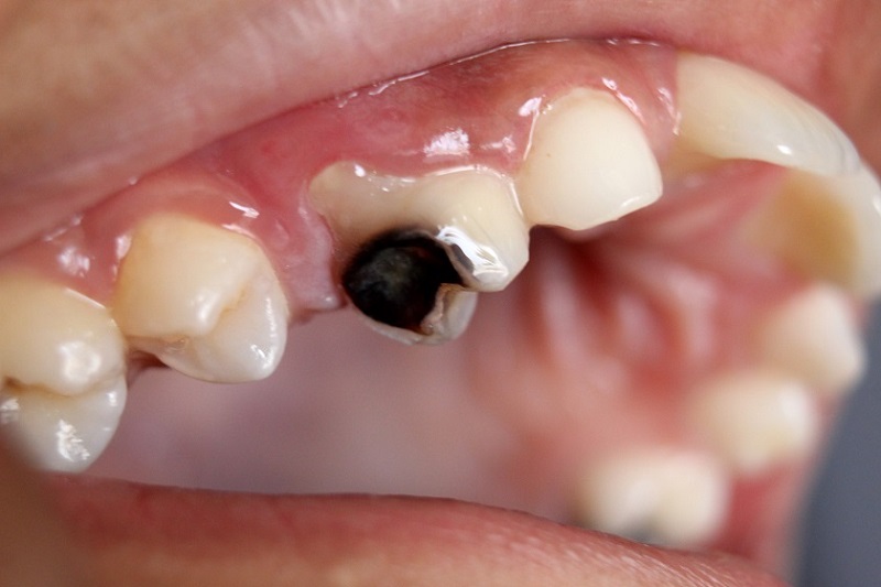 Răng số 4 thuộc nhóm răng hàm nhỏ
