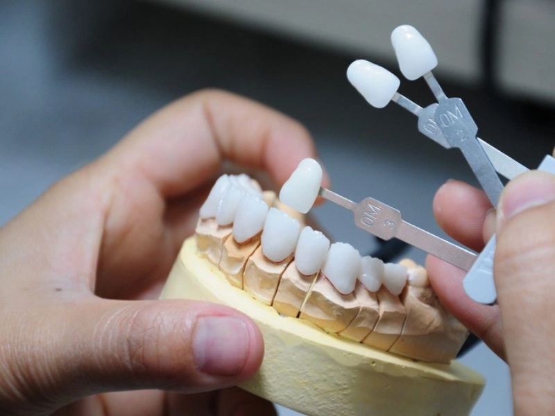 Bọc răng sứ có bị rơi ra không? Nguyên nhân và cách khắc phục 6