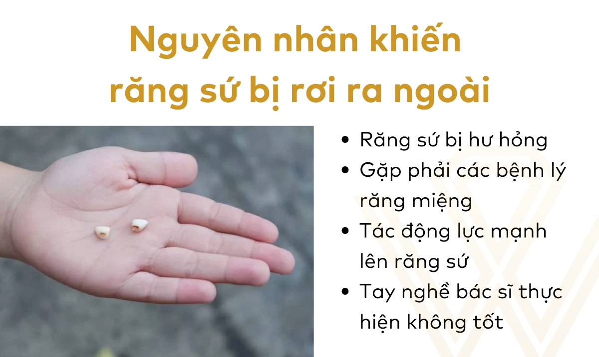 Bọc răng sứ có bị rơi ra không? Nguyên nhân và cách khắc phục 2