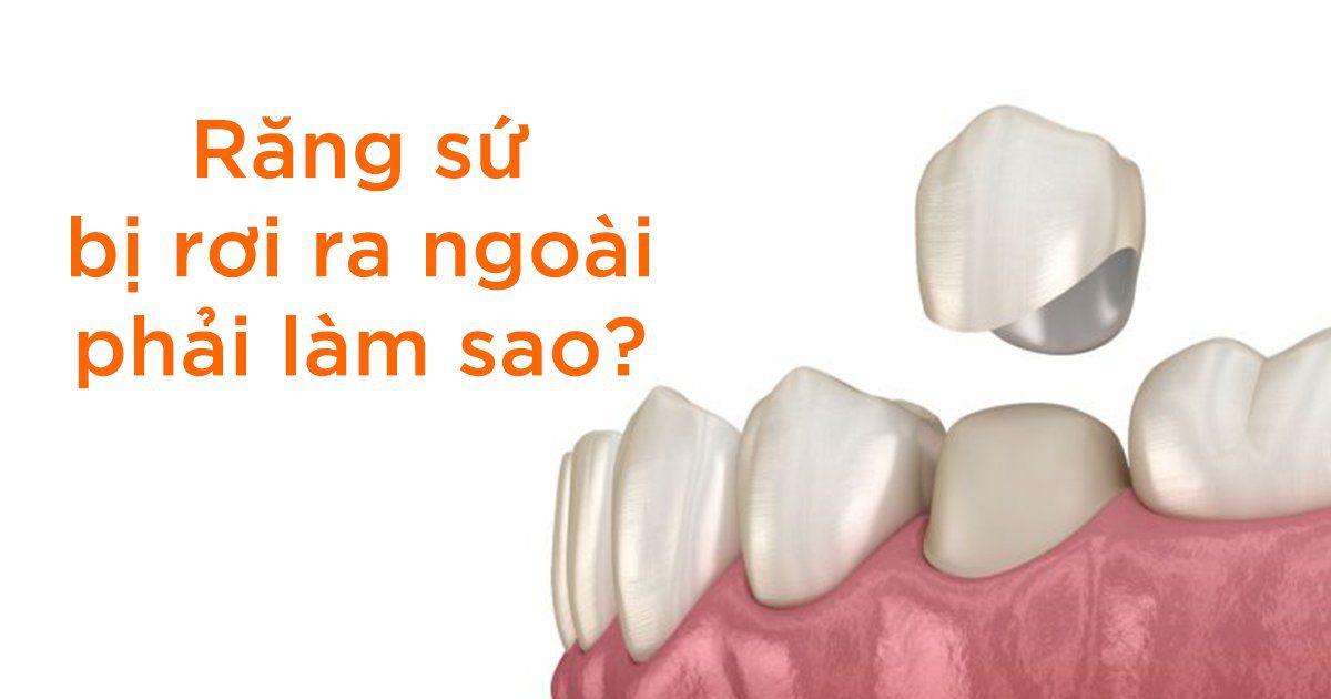 Bọc răng sứ có bị rơi ra không? Nguyên nhân và cách khắc phục 4