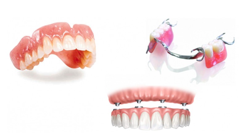 Răng Giả Tháo Lắp 2 Chiếc Có An Toàn Không? Giá Bao Nhiêu? 5