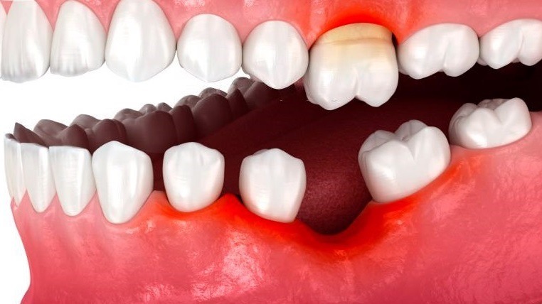 Giải đáp mất răng hàm dưới có sao không? Nguyên nhân - cách khắc phục 1
