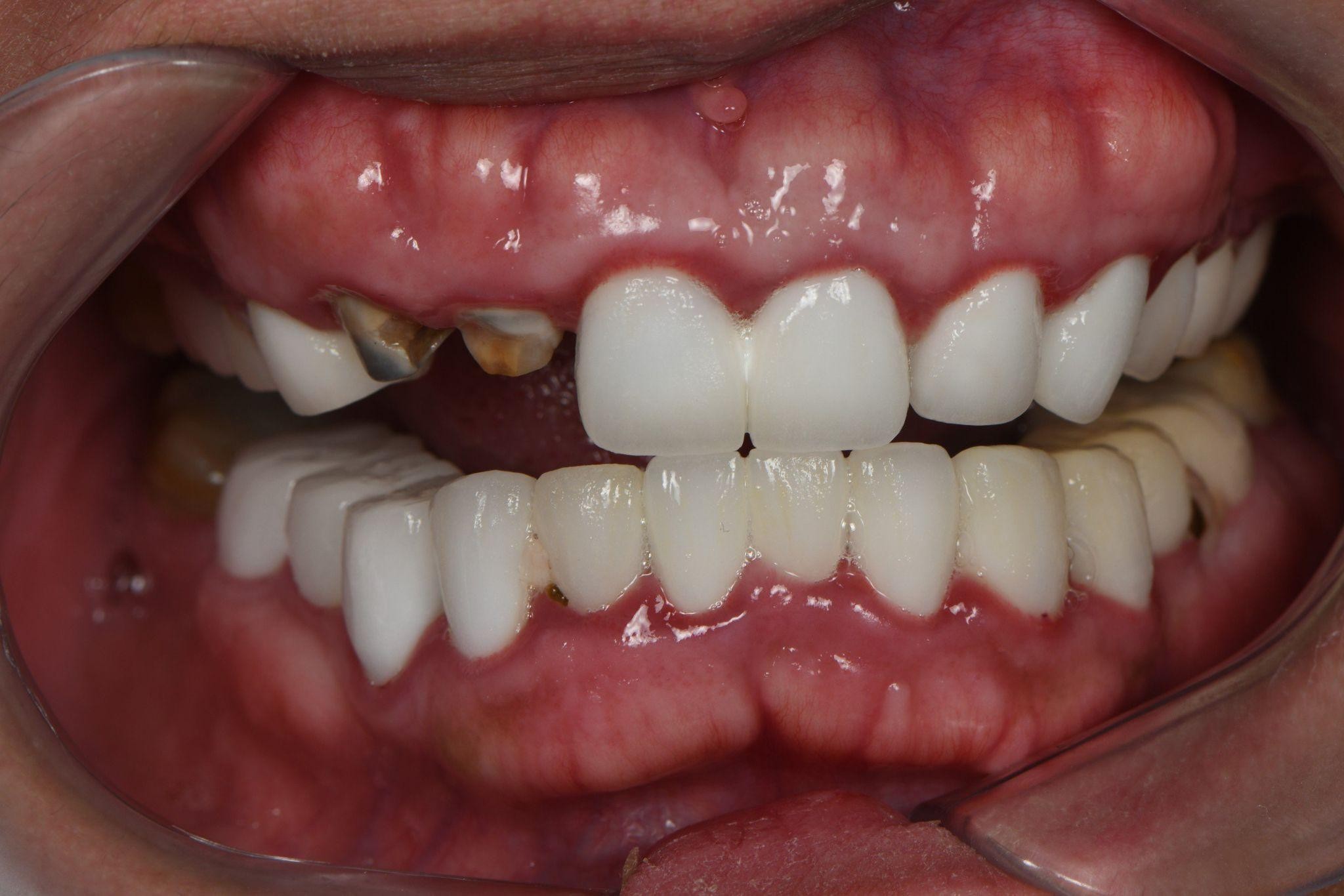 Bọc răng sứ bị viêm lợi, tụt nướu – Nguyên nhân và cách điều trị 2