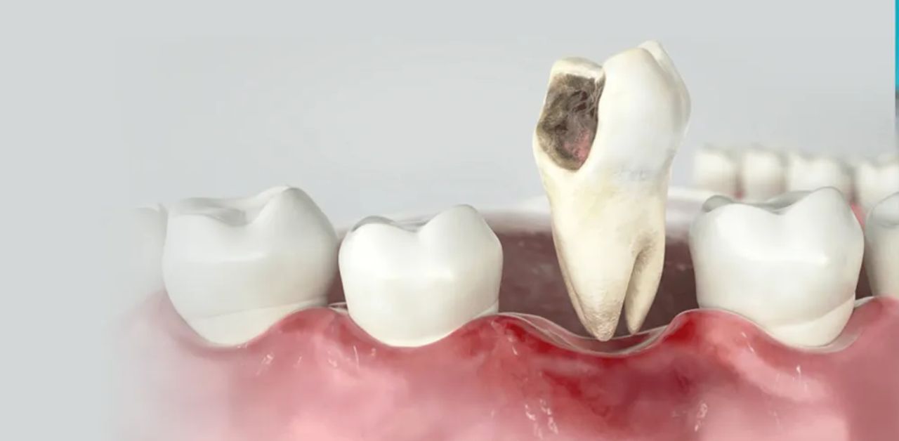 Bọc răng sứ bị viêm lợi, tụt nướu – Nguyên nhân và cách điều trị 2