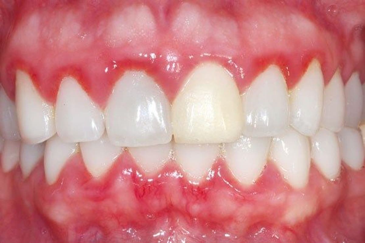 Bọc răng sứ bị viêm lợi, tụt nướu – Nguyên nhân và cách điều trị 3