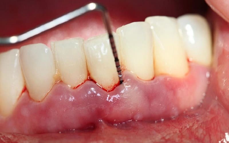 Bọc răng sứ bị viêm lợi, tụt nướu – Nguyên nhân và cách điều trị 4
