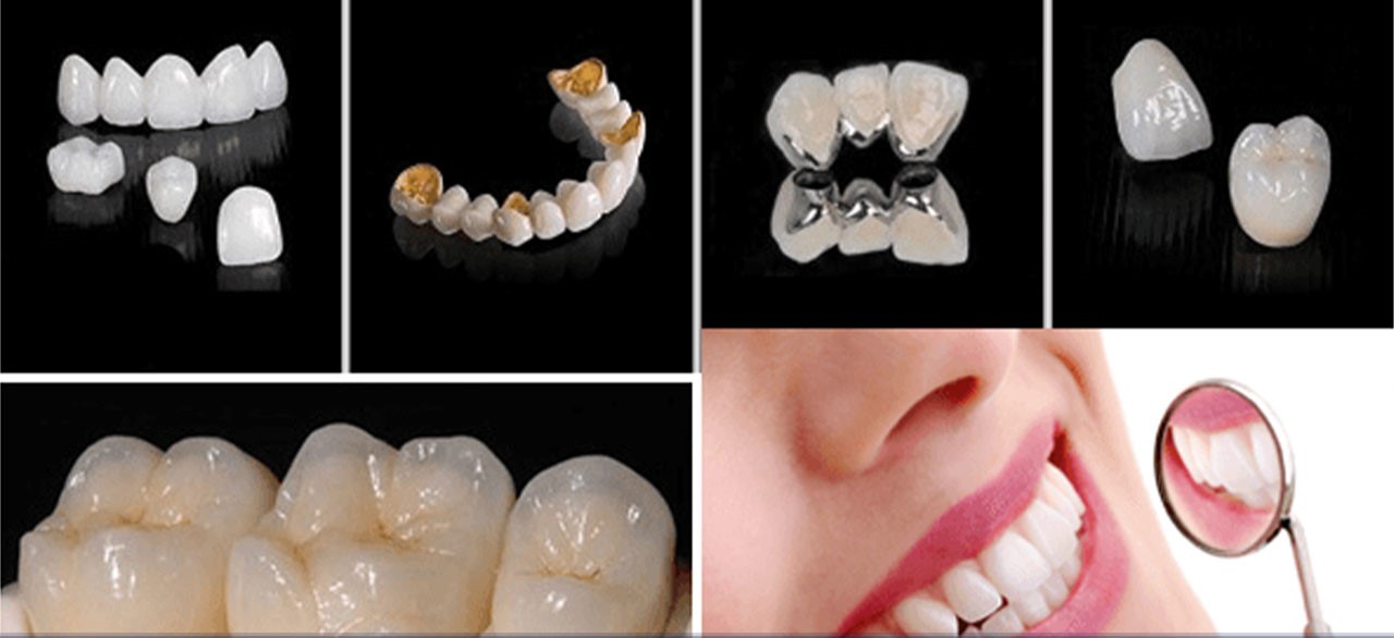 Tư vấn nha khoa: Nên bọc răng sứ kim loại hay Titan? 4