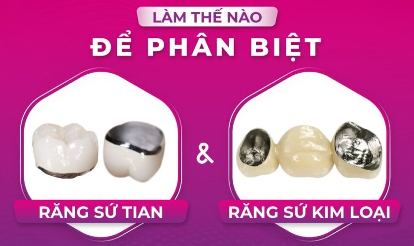 Tư vấn nha khoa: Nên bọc răng sứ kim loại hay Titan? 4