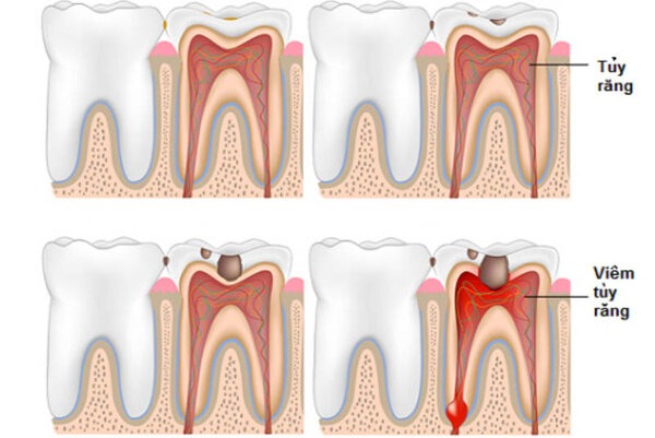 Tủy răng là gì? Cấu tạo và tác dụng của chúng 4