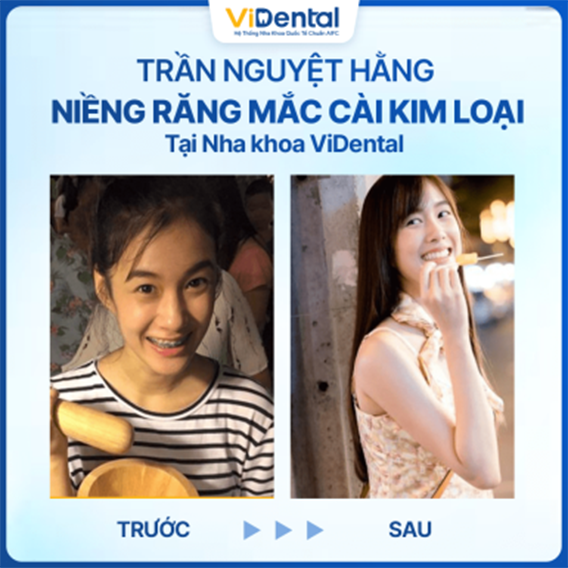 Kh&aacute;ch h&agrave;ng sử dụng dịch vụ Niềng Răng