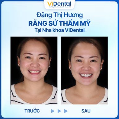 Kh&aacute;ch h&agrave;ng sử dụng dịch vụ Bọc Răng Sứ
