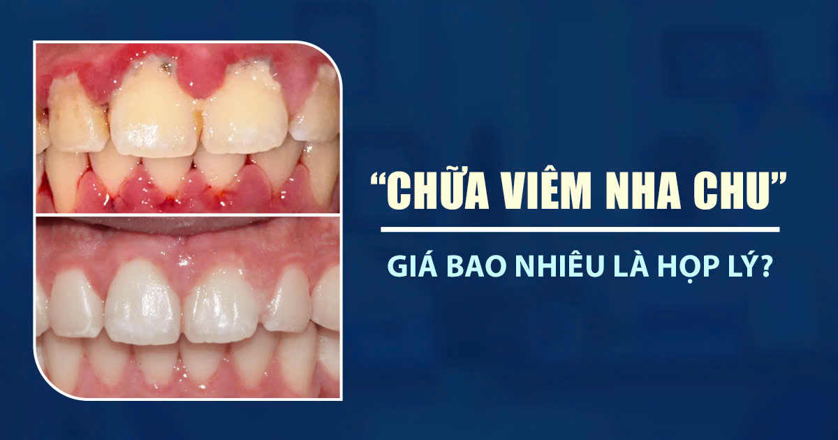 Chữa Viêm Nha Chu Hết Bao Nhiêu Tiền? Giá Bao Nhiêu Là Hợp Lý 4