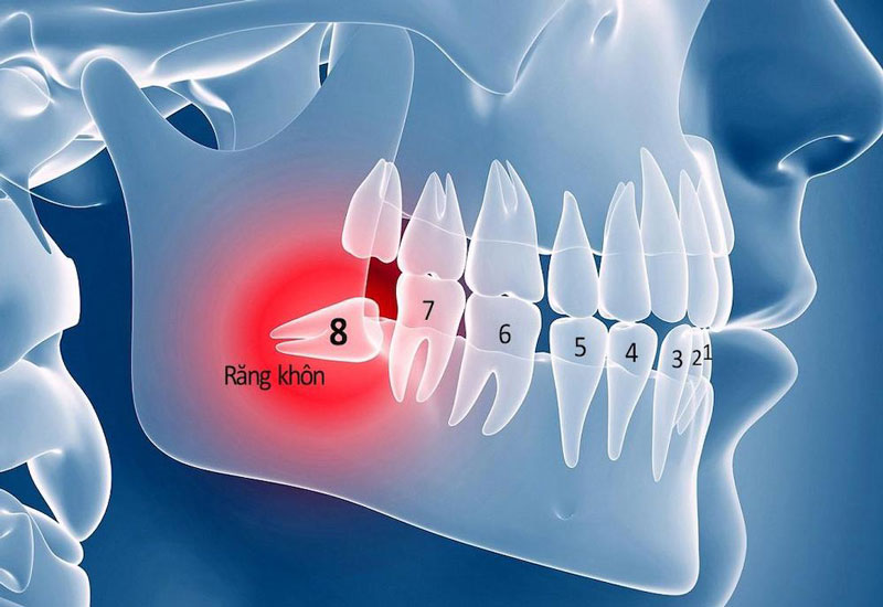 Nhổ Răng Khôn Có Nguy Hiểm Gì Không? 7 Biến Chứng Cần Biết 3