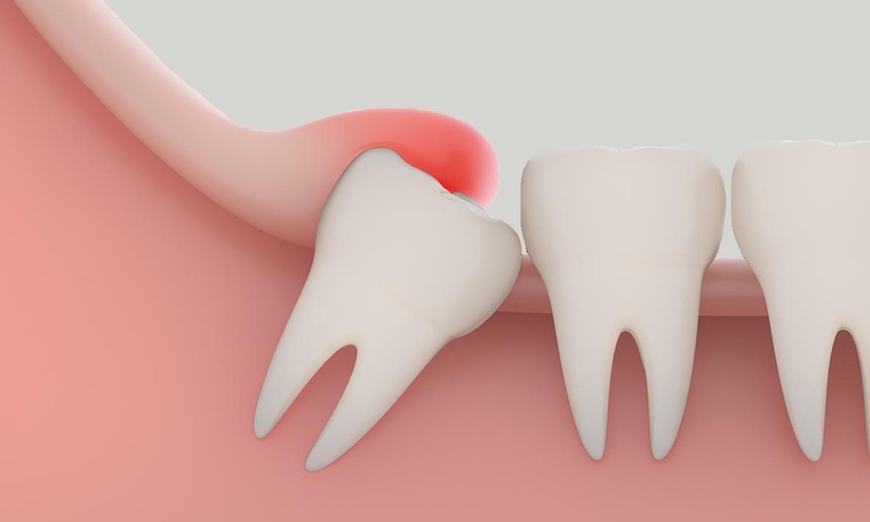 Làm Sao Để Biết Răng Khôn Mọc Thẳng? Và Khi Nào Cần Lo Lắng? 2