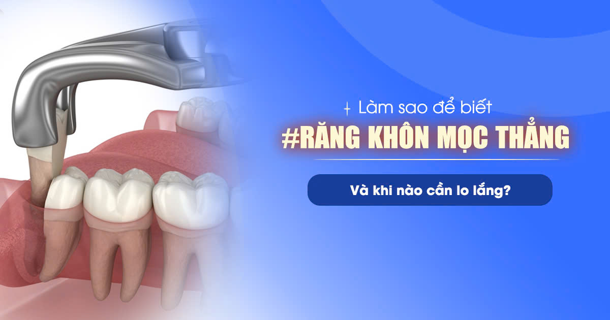 Làm Sao Để Biết Răng Khôn Mọc Thẳng? Và Khi Nào Cần Lo Lắng? 1