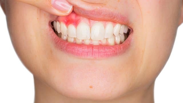 Sưng Nướu Răng Bao Lâu Thì Khỏi? Nguyên Nhân và Cách Điều Trị 2
