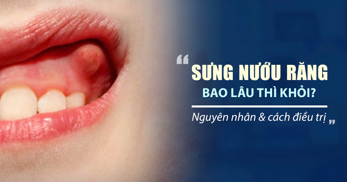 Sưng Nướu Răng Bao Lâu Thì Khỏi? Nguyên Nhân và Cách Điều Trị 1